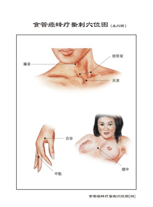 食管癌的蜂疗医治法