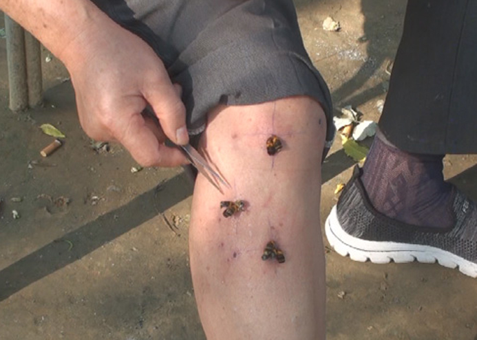 胡蜂蜂疗：胡蜂蜂针蜇刺现场解说（2017－9－13）