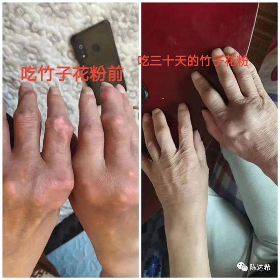 “竹子花粉”是痛风的克星