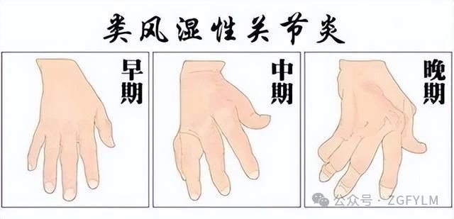 蜂胶+蜂王浆：类风湿关节炎的双面解药